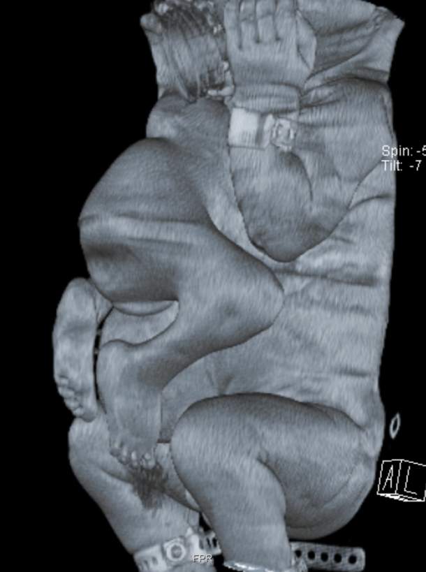 הדמיית ה-CT של התינוק לפני הניתוח